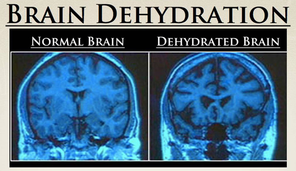 brain dehydration