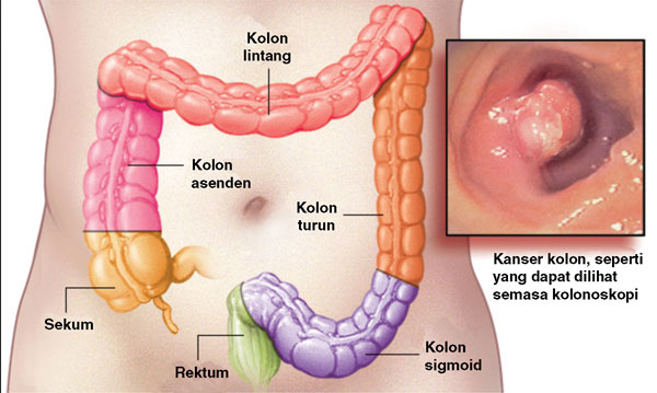 kanser usus